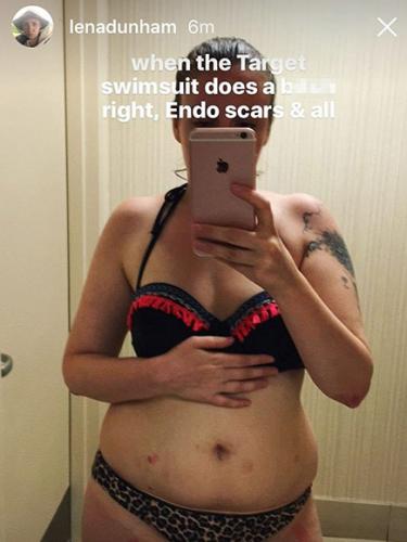 LENA DUNHAM s'AFFICHE en BIKINI pour PARLER de son ENDOMÉTRIOSE