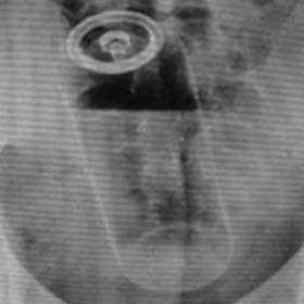 OBJETS IMPROBABLES dans le RECTUM ? Ces radiologues postent les IMAGES !