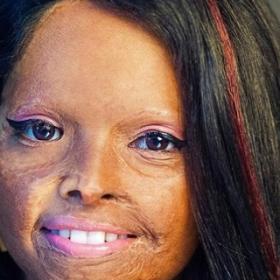 Elle devient ÉGÉRIE d'une MARQUE après avoir été DÉFIGURÉE à l'ACIDE