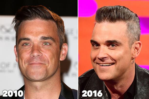 ROBBIE WILLIAMS : son visage est PARALYSÉ ??