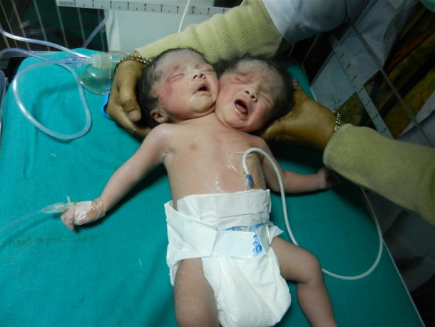 Elle ACCOUCHE d'un BÉBÉ à DEUX TÊTES